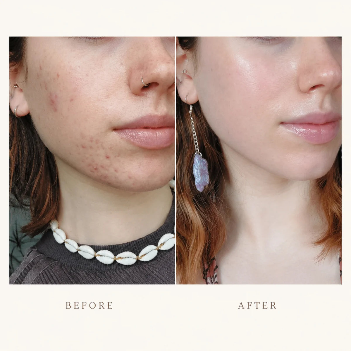 PimpleFix™ Hydrocolloid Roll